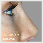Nose reshaping